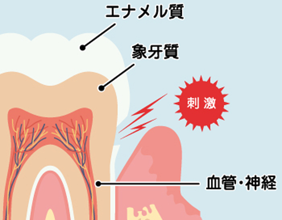 岡崎市の歯医者、ヒロデンタルオフィスの歯ぎしり、食いしばり