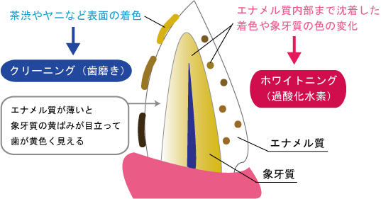 岡崎市の歯医者、ヒロデンタルオフィスのホワイトニング